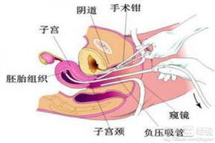 女子流产手术七个月后查出癌症，生命的挑战与坚韧